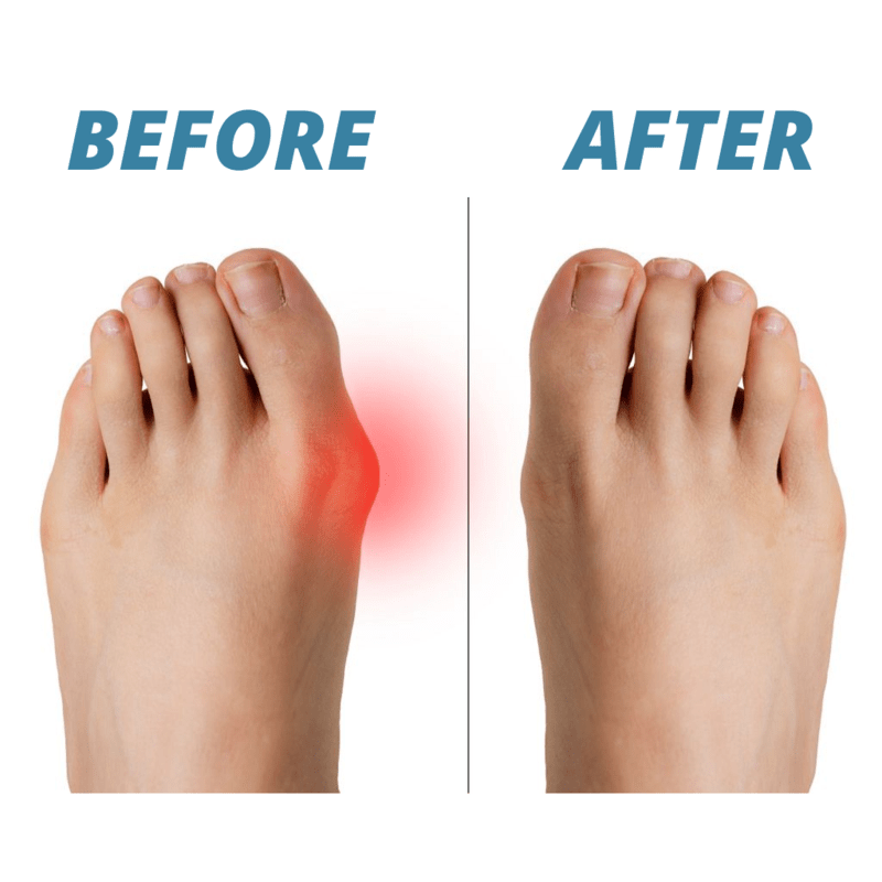 BunionCorrect™ - Eliminate Bunion Pain For Good! - 1+1 Free